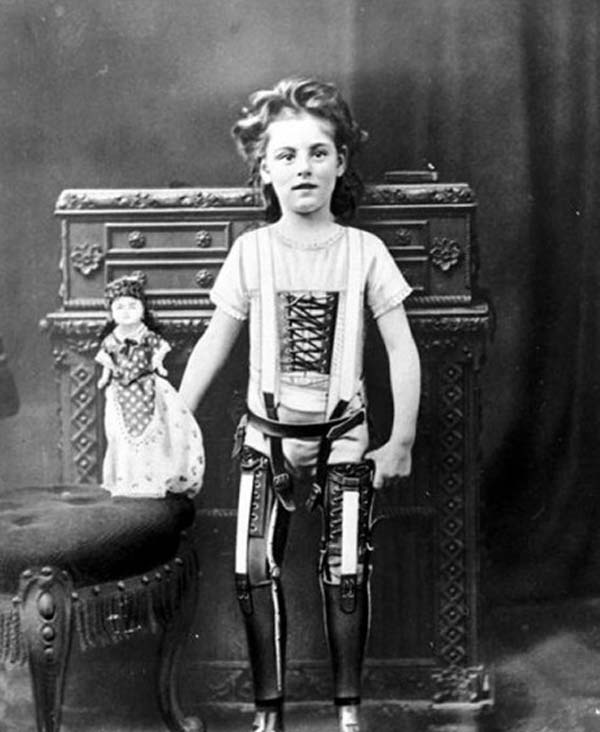 jeune fille avec des prothÃ¨ses artificielles, en 1898